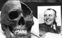 Le crâne de Martin Bormann - Histoire de la médecine
